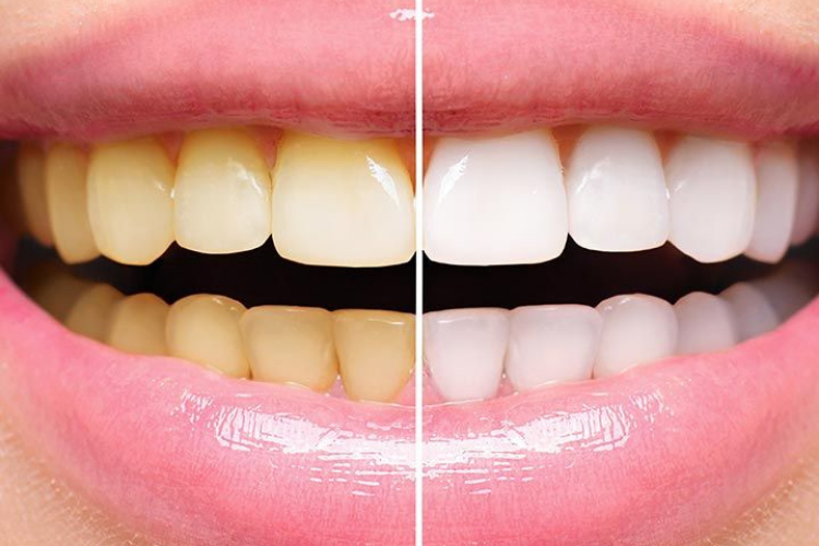Teeth Whitening